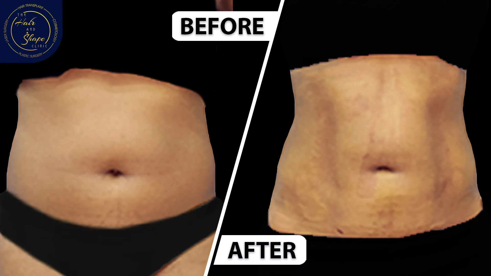 Liposuction result4